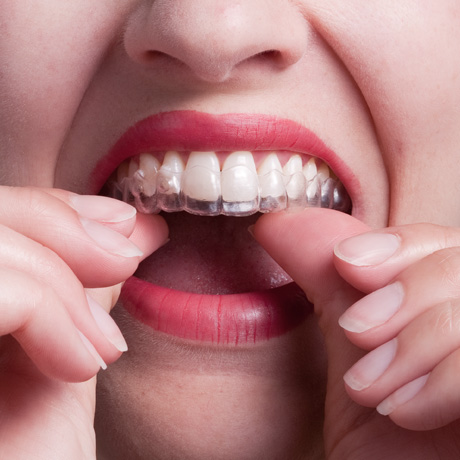 Invisalign