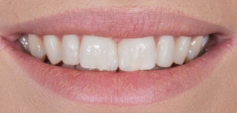 After treatment