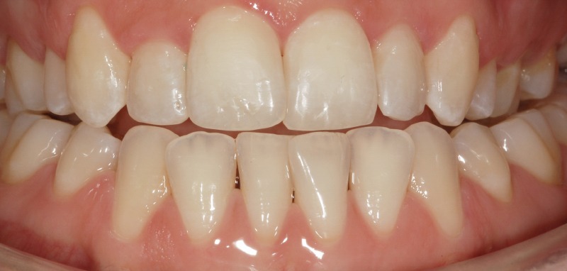 After treatment