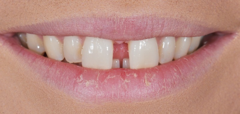 Before treatment