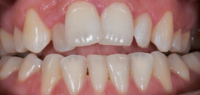 Before treatment