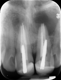 , Root Canal Treatments