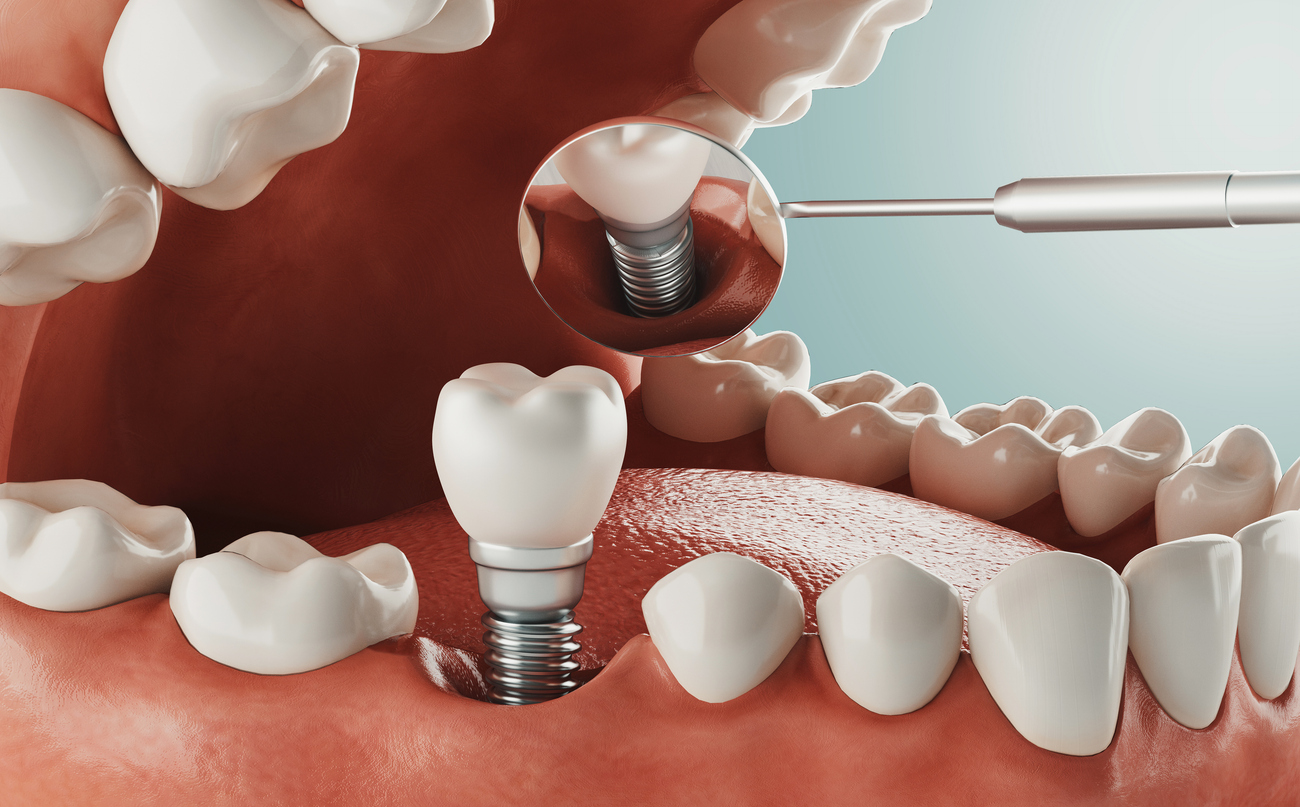 showing a dental implant inside mouth